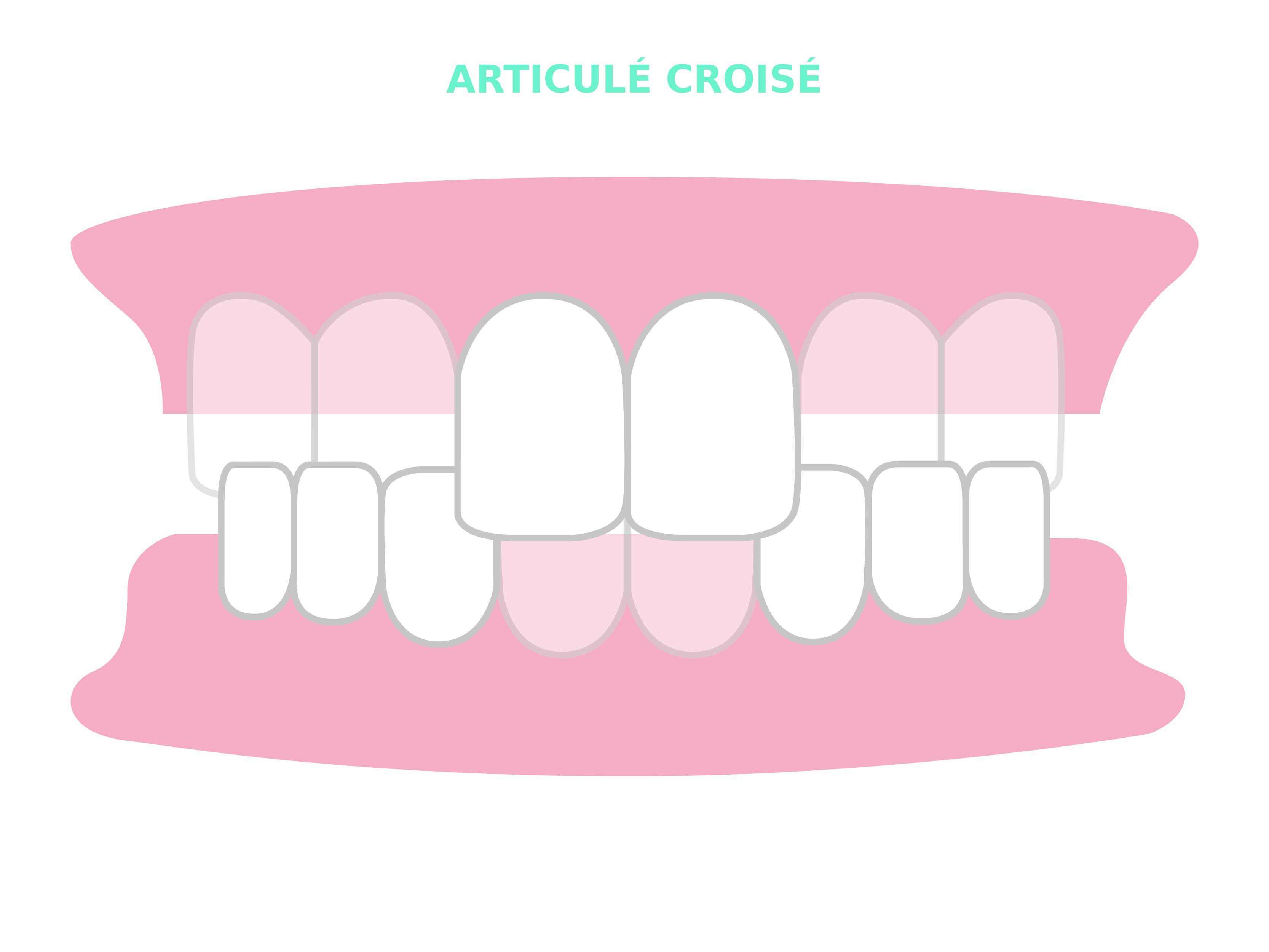 Résultats et cas traitables Smilers® - articulé croisé