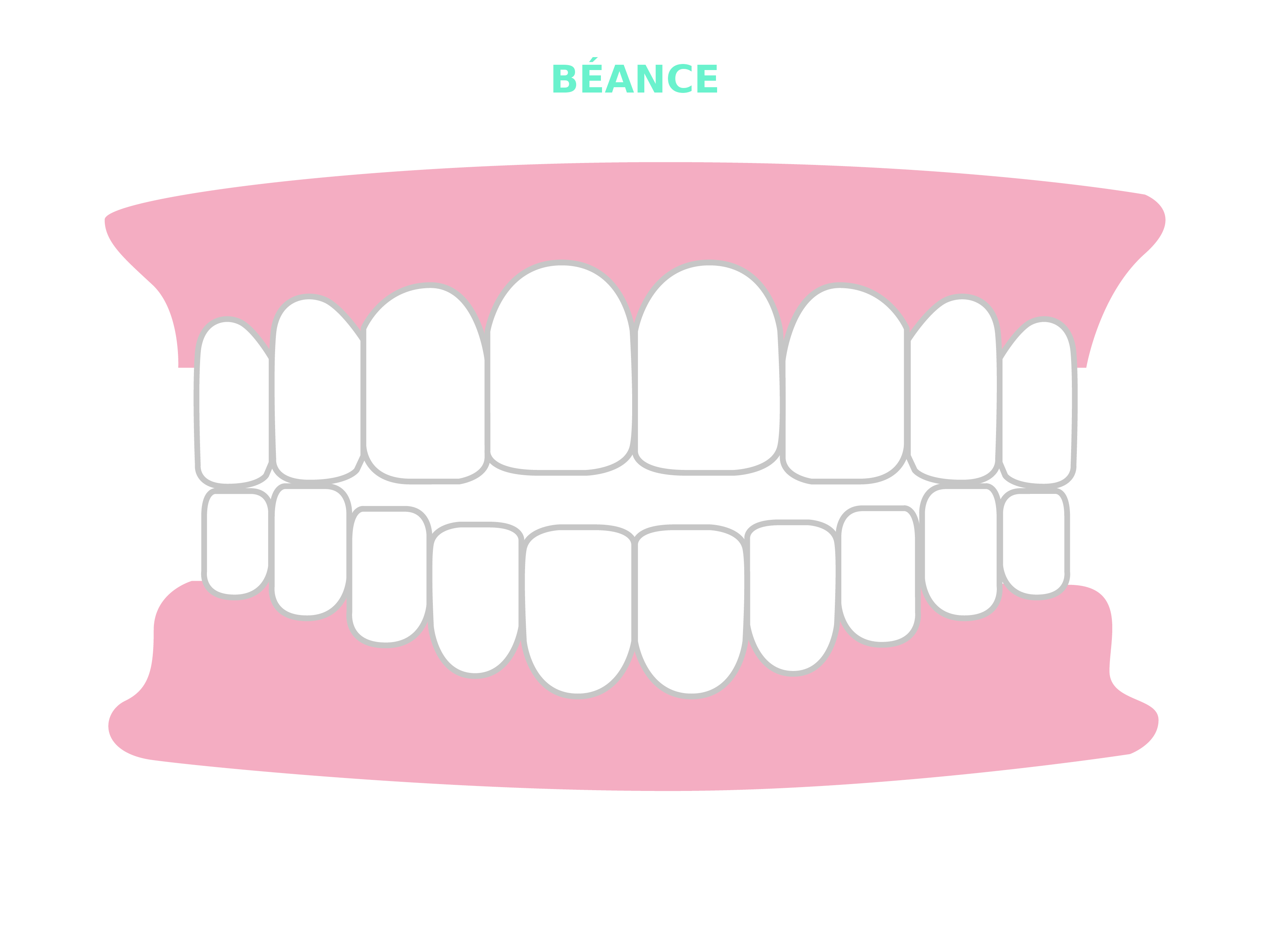 Résultats et cas traitables Smilers® - béance