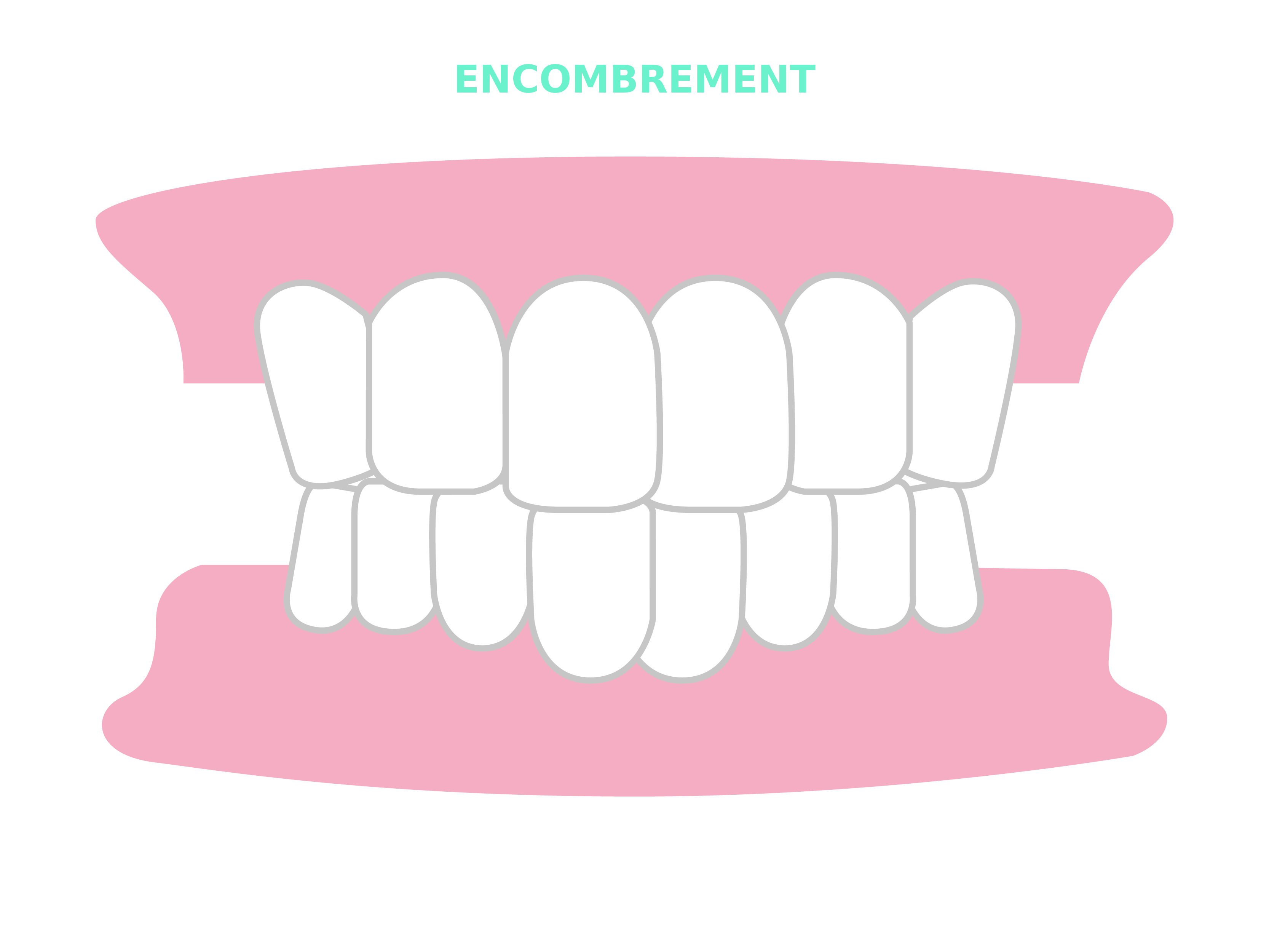 Résultats et cas traitables Smilers® - encombrement