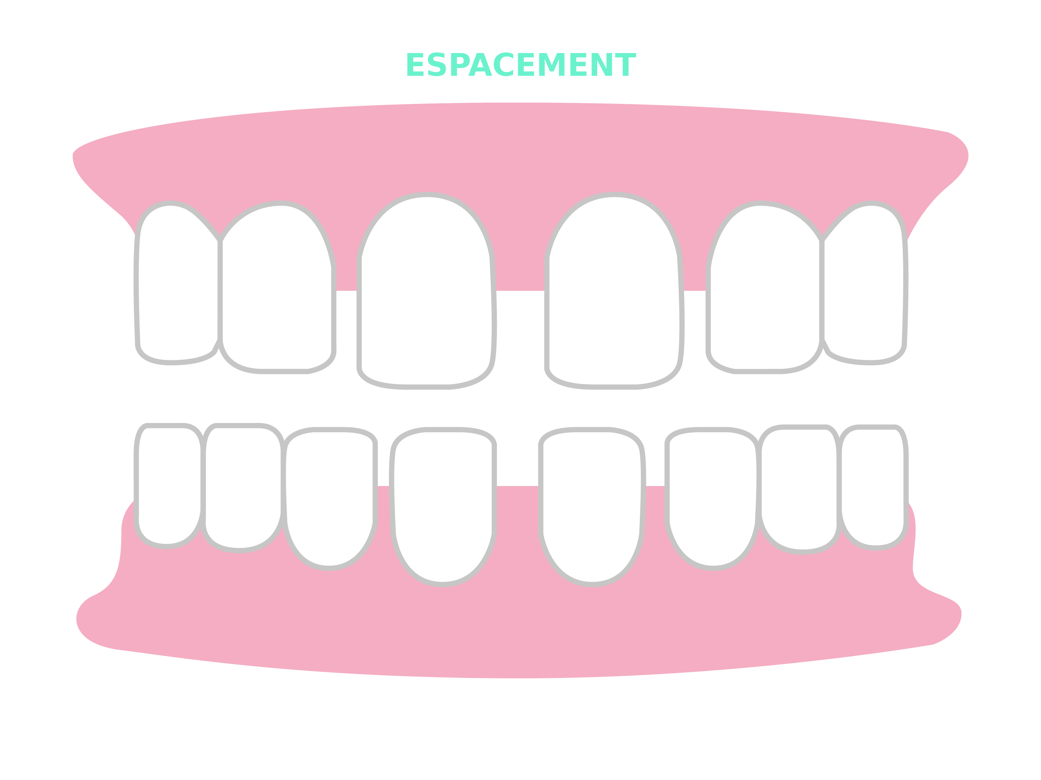 Résultats et cas traitables Smilers® - espacement, écart entre les dents