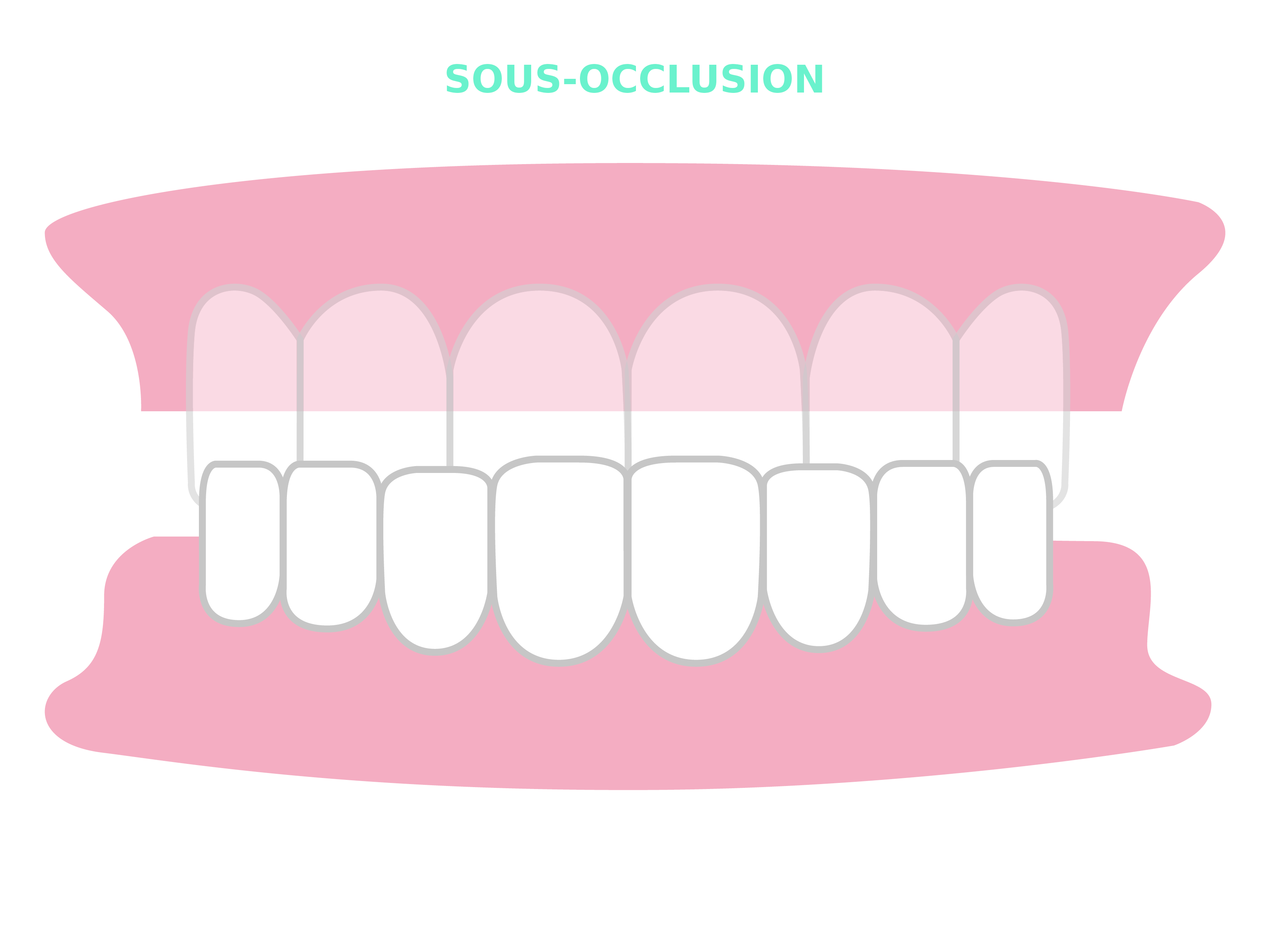 Résultats et cas traitables Smilers® - sous-occlusion