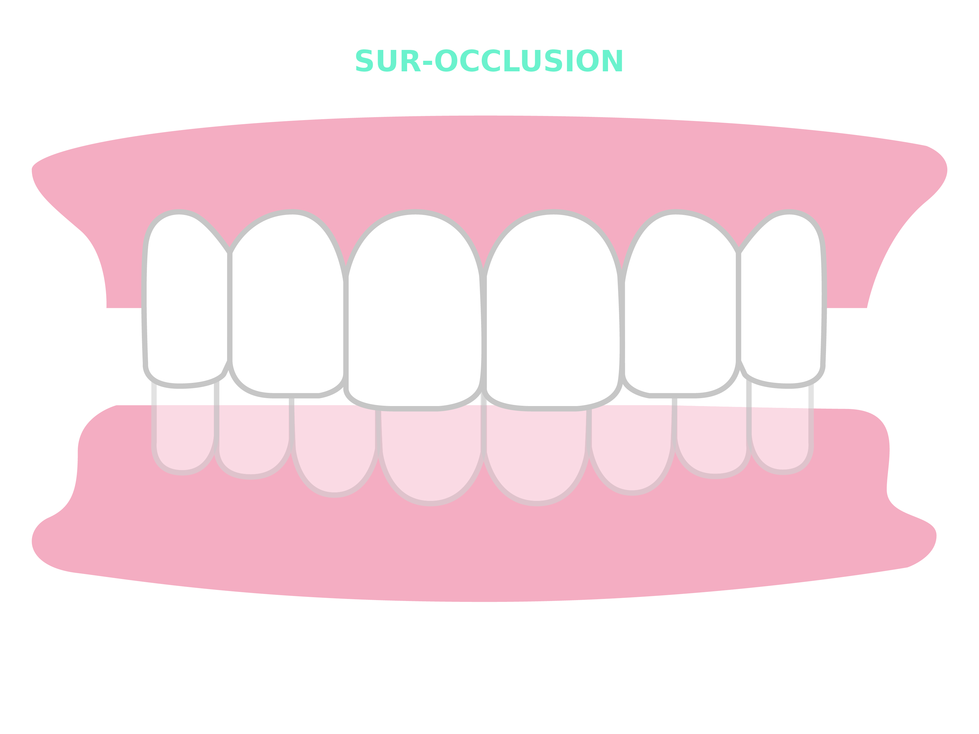 Résultats et cas traitables Smilers® - sur-occlusion